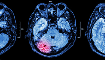 Brain scan highlighting an abnormal area in the lower rear of the brain.